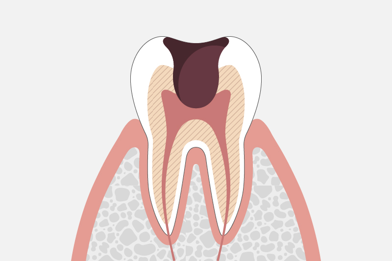 虫歯治療